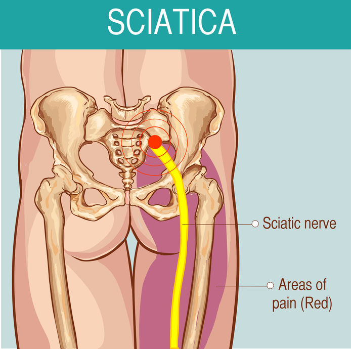 Sciatica Pain Illustration