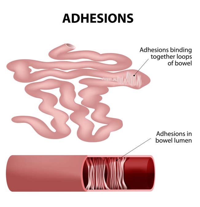 Abdominal Adhesions graphic