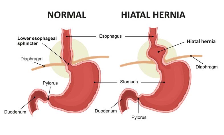 Hiatal hernia comparison chart
